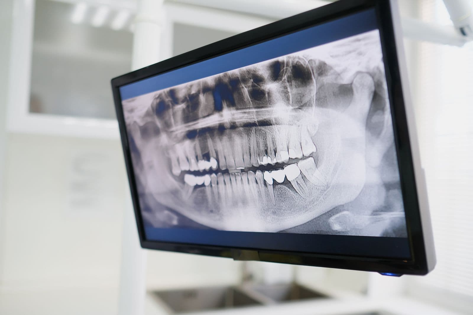 Diş kliniğinde monitörde görüntülenen panoramik diş röntgeni