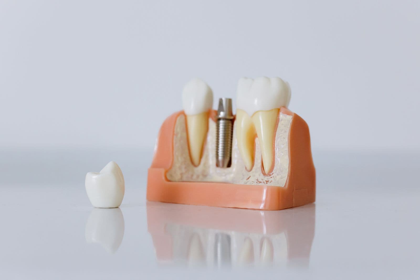 Diş implantı modeli ve porselen kron yakın çekim
